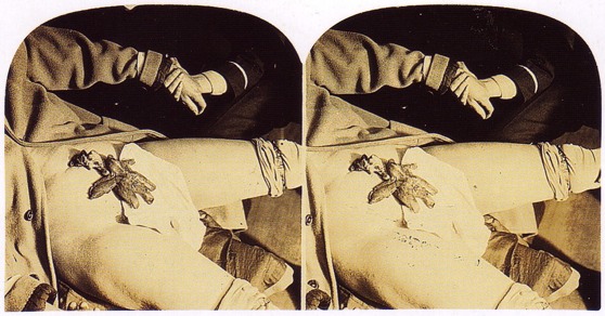 Stereo slide of Crandon's "hand"